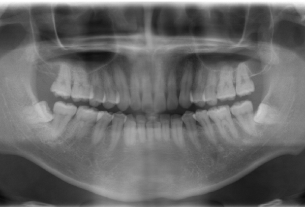 パノラマレントゲン撮影