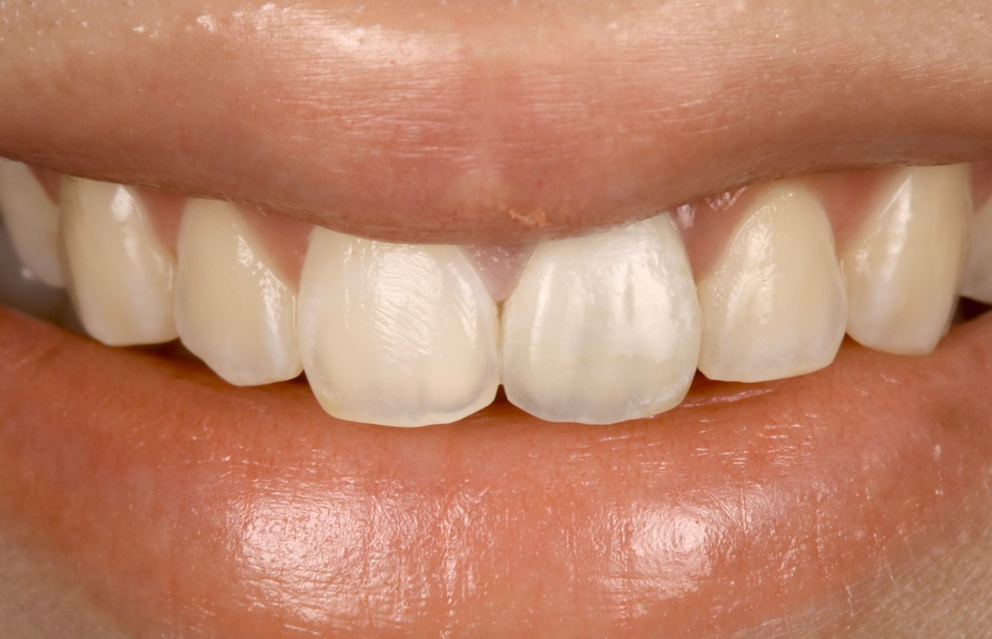 セラミック修復 後