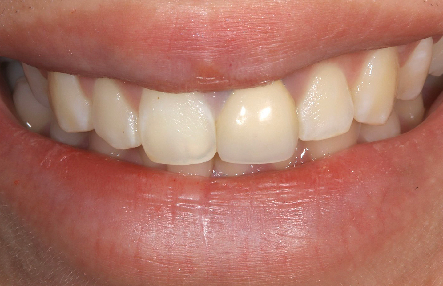 セラミック修復 前