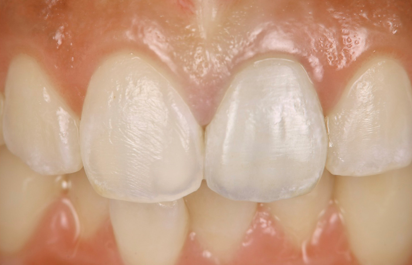 セラミック修復 後