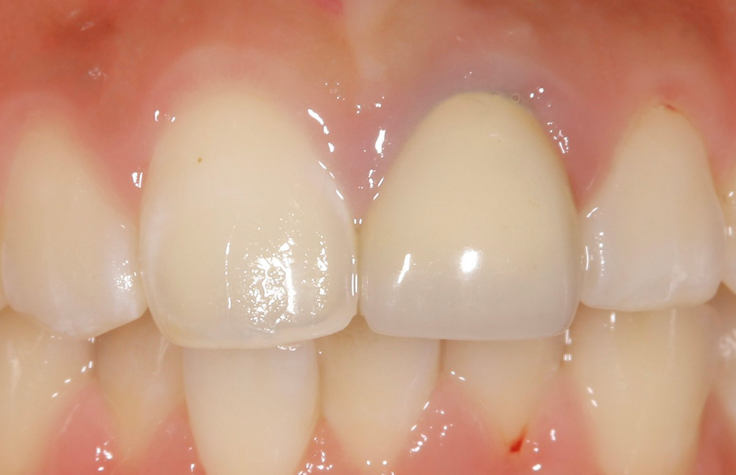セラミック修復 前