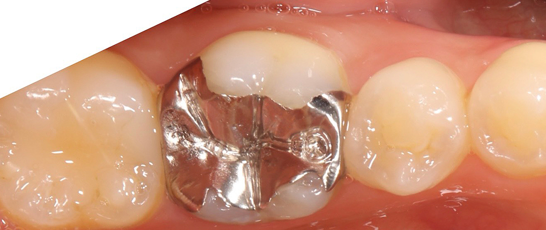 インレー修復 前