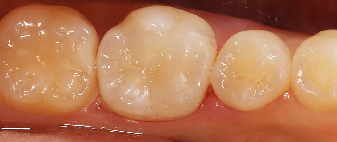 インレー修復 後1