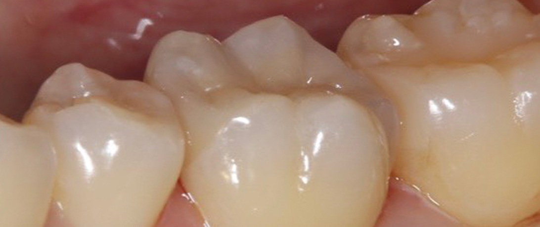 インレー修復 後2