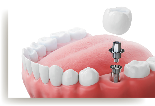 インプラントの画像
