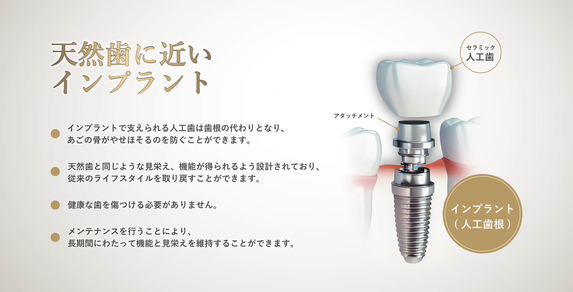 インプラントの説明