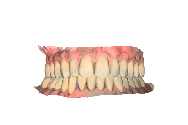 口腔内スキャナーによる3Dスキャン