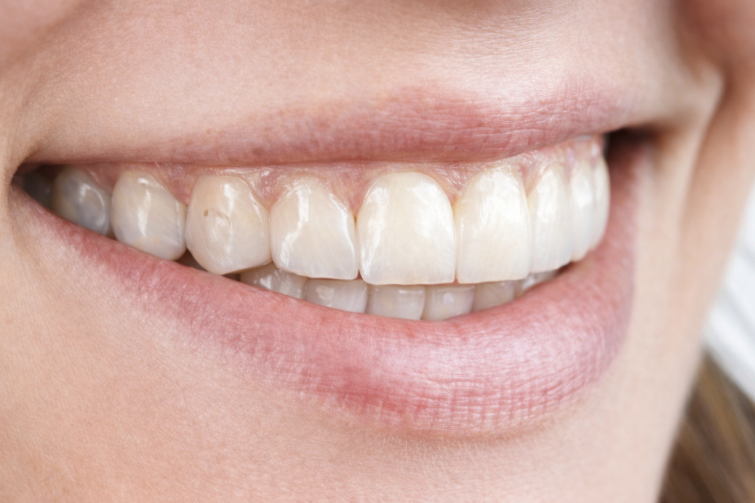 マウスピース矯正のメリット・クリアコレクトの特徴